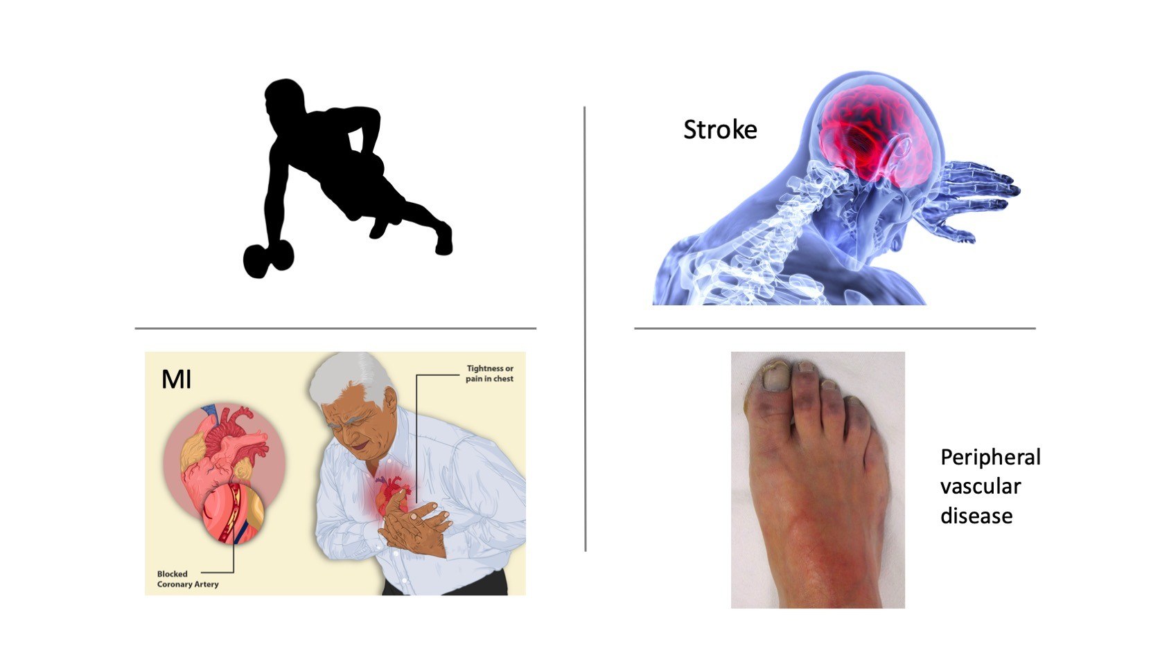 Exercise and macrovascular complications.